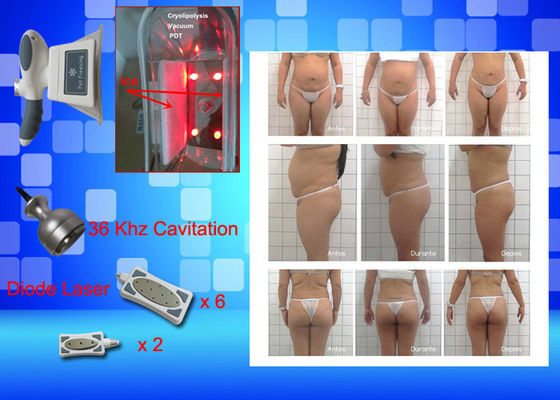 Cryo замерзая вес оборудования лазера Lipo теряет домашнюю машину красотки